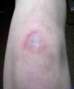 My battle wound